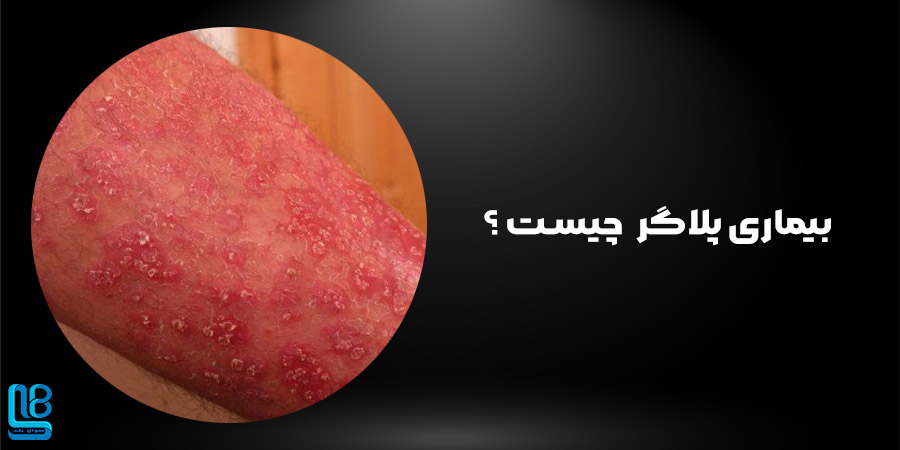بیماری پلاگر   چیست ؟